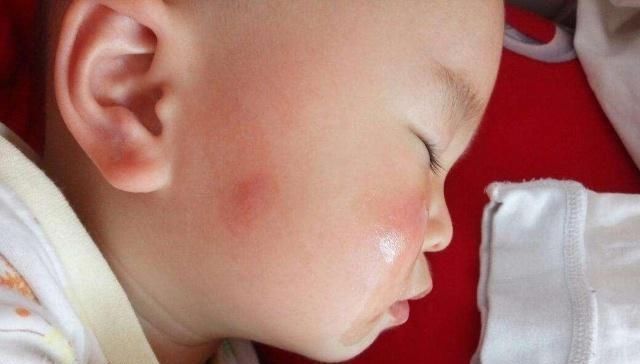 吸引力|你的孩子是吸引的蚊子“磁铁”吗他经常被咬的5个原因