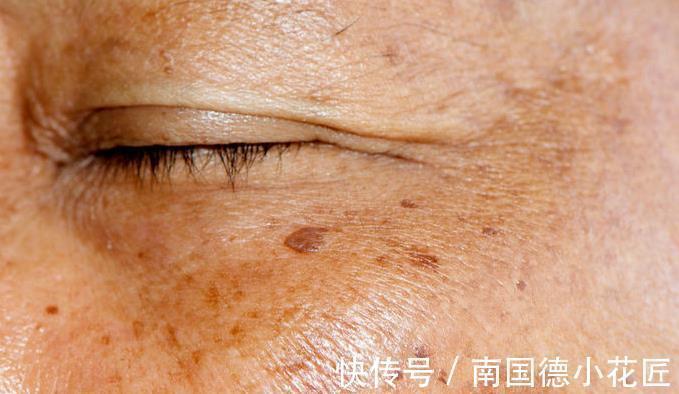 维生素c|早早出现老年斑,提醒:无非4个原因,常吃2物,预防老年斑