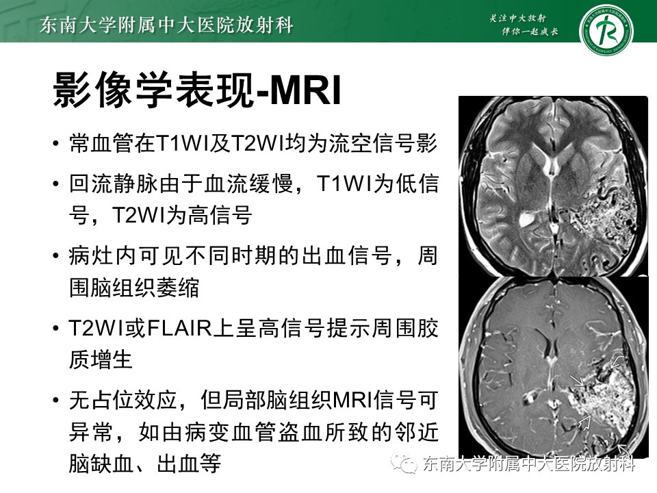 脑动静脉畸形 影像表现