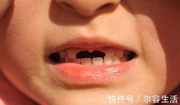 双排牙|越来越多孩子长“双排牙”，与糖果无关，是父母喂养有误区