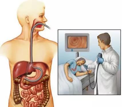 医生|做胃镜，选普通的，还是无痛的？医生帮你详细分析一下