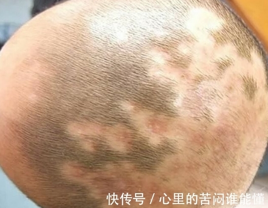 满月头|婆婆带宝宝去剃满月头，几个月后孩子成了这样，医生怒斥家属无知