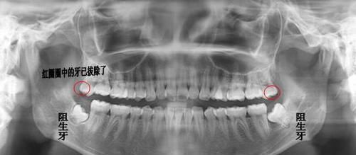 智齿|智齿是人体正常的结构吗一定要拔掉它吗