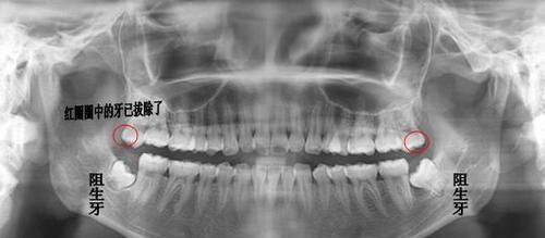  智齿|智齿是人体正常的结构吗一定要拔掉它吗