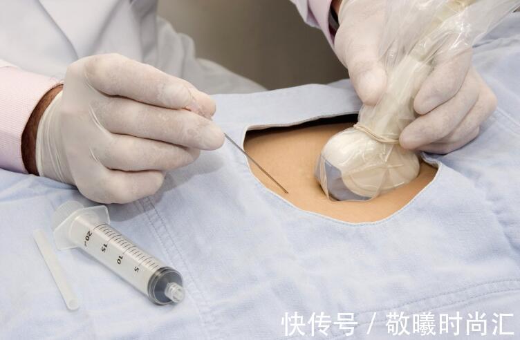 染色体|同样是怀孕,为啥单胎需要做唐氏筛查和四维彩超?而双胎没必要做