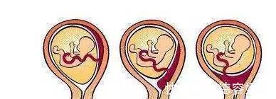 胎盘|如果孕期发现这5种异常出血情况,立刻去医院!