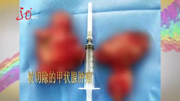 胸腔|真危险!肿瘤从老人脖子长到胸腔!四分之三以上气管被堵死!