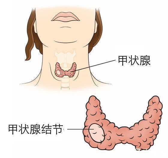 结节|吃碘与不吃碘，和甲状腺结节有何关系？