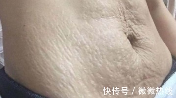 精华乳|怀孕后害怕身上长妊娠纹,注意这些要点,让妊娠纹离得远远的!