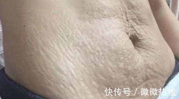 精华乳|怀孕后害怕身上长妊娠纹，注意这些要点，让妊娠纹离得远远的！