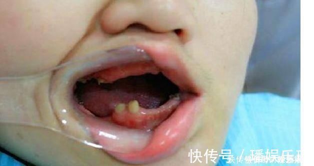 家里面|6岁男童被查出牙龈癌晚期,牙齿掉光了,孩子爱喝家长要警惕