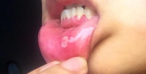 得癌|身上突然摸到肿块,就一定是得癌了?不同位置或暗示不同问题