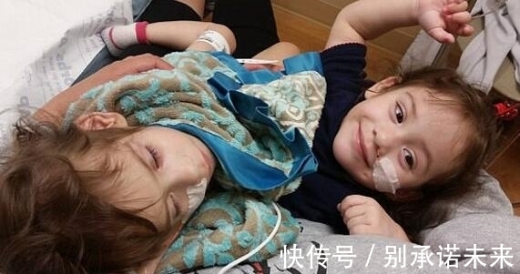 姐妹花 这对连体姐妹花,手术成功分离,每人拥有一条腿,未来的路很艰难