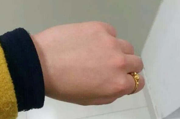 疹子|手部出现四大变化，有可能是血糖过高，不占说明血糖还稳定