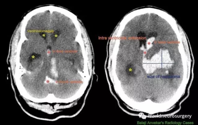 颅内血肿|颅内血肿体积计算公式~超级实用