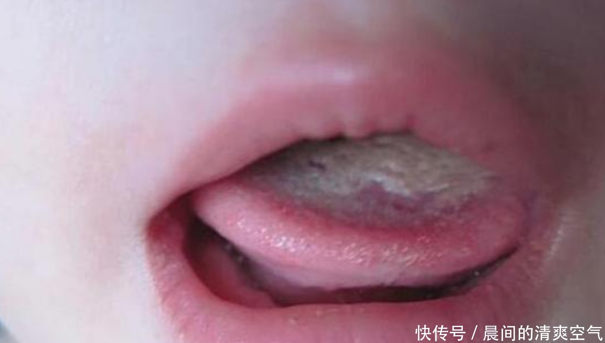 6岁男童积食不长个,医生看舌苔后捂鼻问:“防腐剂”吃了多少