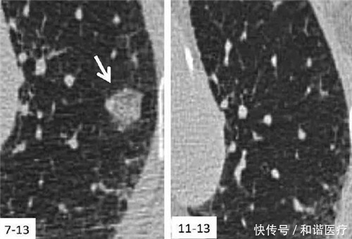 肺结节是肺癌前兆吗?要不要切?