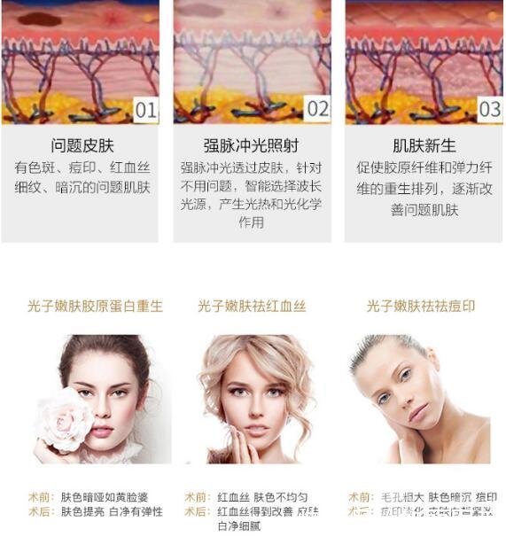 痤疮 怎么去痘|日常战痘还不够，4种医美光电项目来帮你get干净皮肤！
