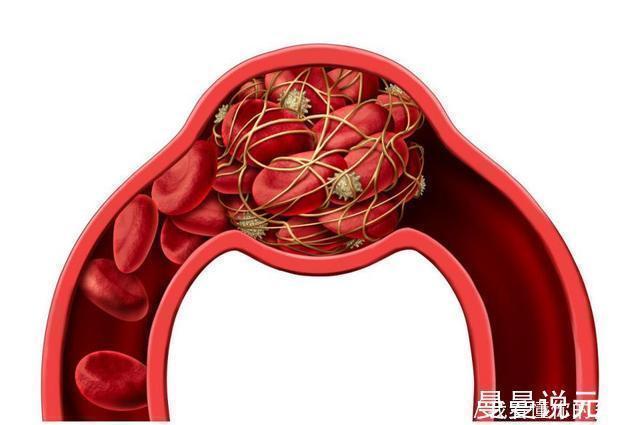 心脏病|血脂高的人吃他汀是对的吗身体有3种不适,尽快停药,谨防心梗