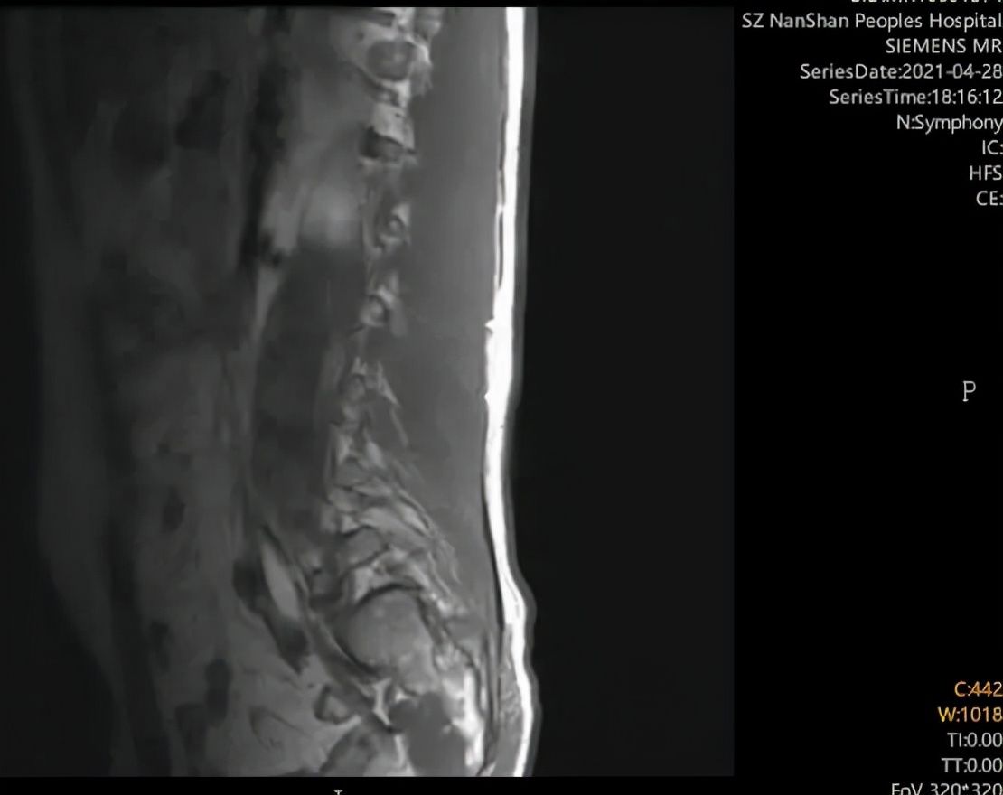 布鲁氏菌|28岁男子发热20多天，吃感冒药也不好转，只因一个拥抱