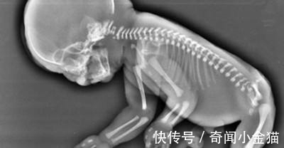 美人鱼|那个“美人鱼”女婴,出生时吓坏众人,他现在过得怎么样了?