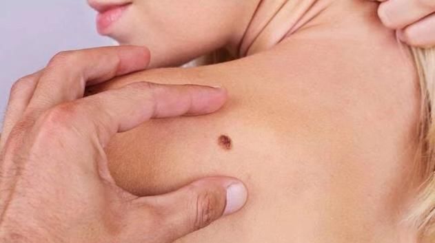 癌症|4个部位长出痣,为健康最好定期检查,以防癌症悄悄接近你