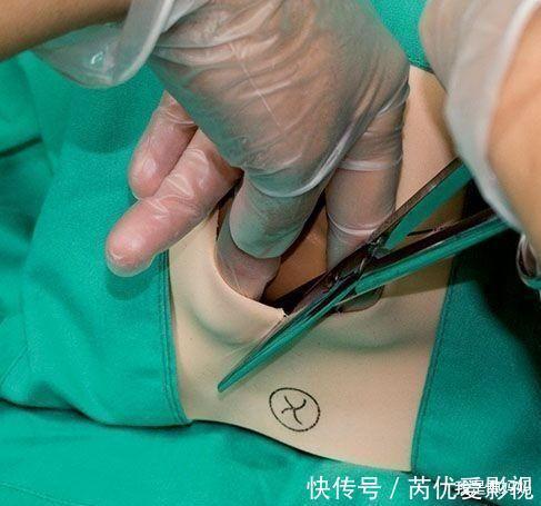剖腹產|同樣是“一刀”,側切和剖腹產區別有多大?這7大區別你未必想得到