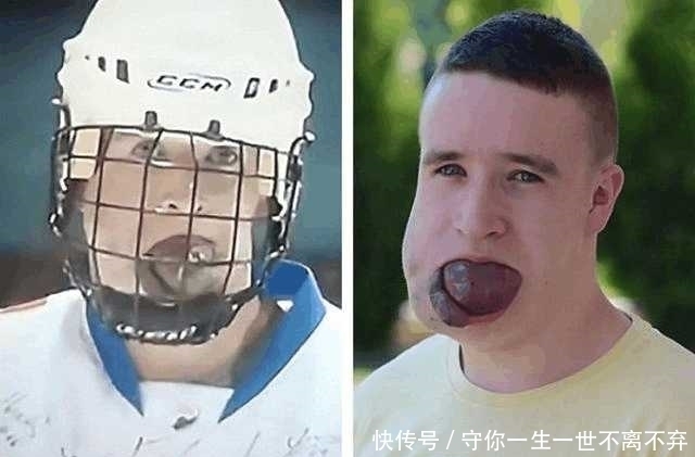 舌头|从小长着巨大舌头的男孩, 睡觉都可能窒息!