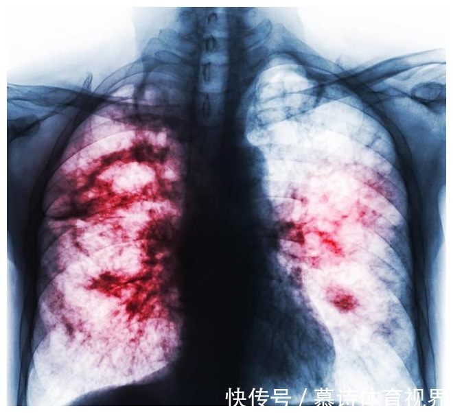 肺腺癌|最近收治一个肺腺癌病人,真的是我见过病情发展最快的一个病人