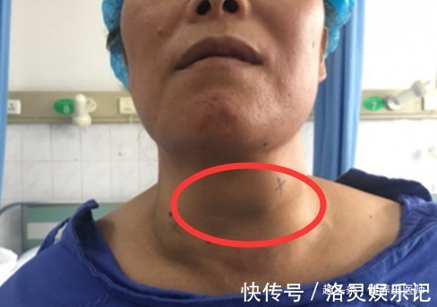 女性|女性有癌，脖子先知！脖子出现这种情况，建议你最好赶紧去检查！