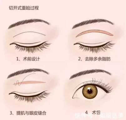 创伤 双眼皮手术方式:埋线、全切、韩式三点怎么选?你的手术方式选对了吗?