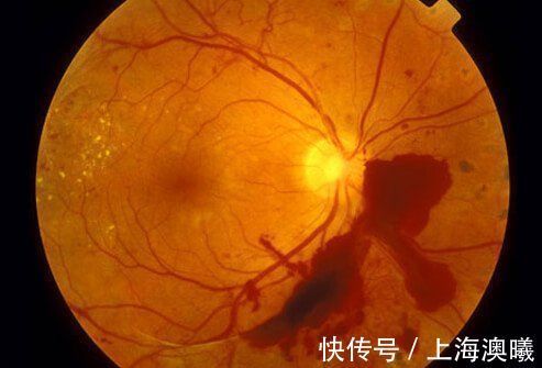 视网膜|二型糖尿病并发症有哪些？