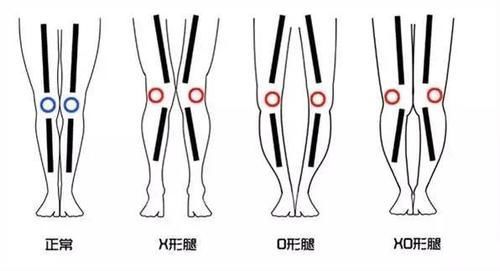 膝关节|膝关节炎的主要发生人群，赶紧看看，有没有你？