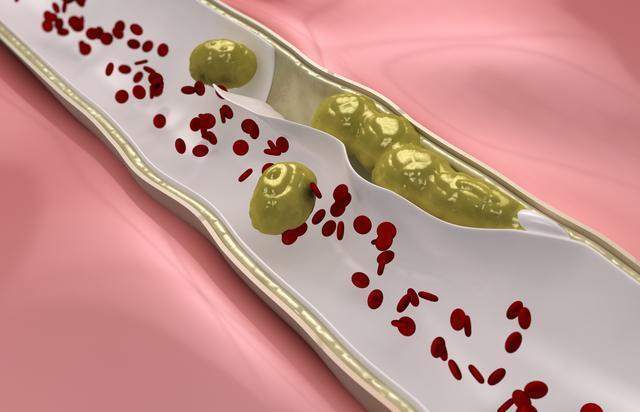 动脉粥样硬化斑块|高血脂两个月后降到正常!他没有吃药,全得益于做的三个正确决定