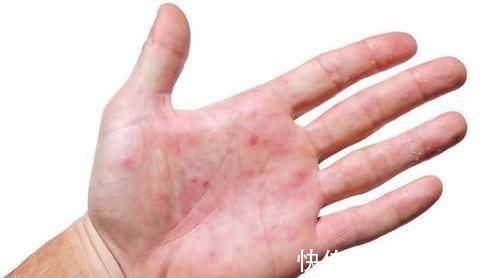 指甲盖|肝不好看手,肾不好看脚,你没有这些特征说明你的肝肾还算健康