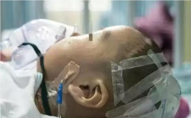 脑出血|1岁健康宝宝脑出血,只因奶奶用老方法哄睡,家长要引以为戒