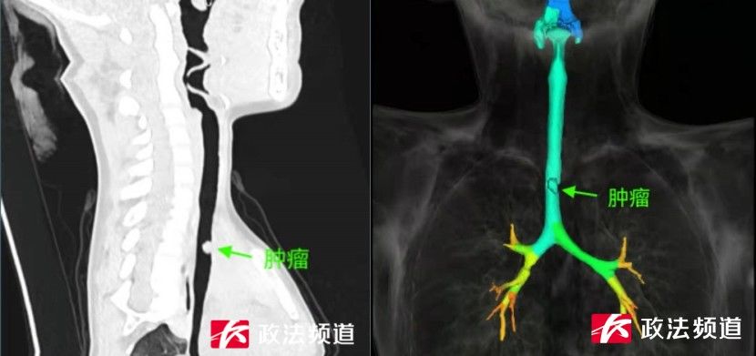 咳嗽|长沙8岁女孩咳嗽一个月不见好 竟是气管内长肿瘤