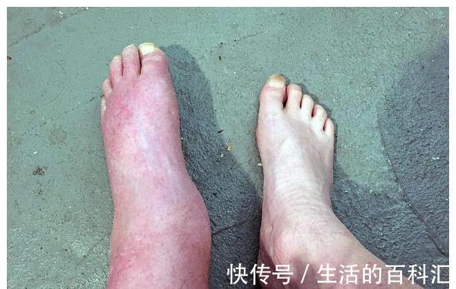 信号|肾衰竭早期,身体会有信号吗?别漠不关心了