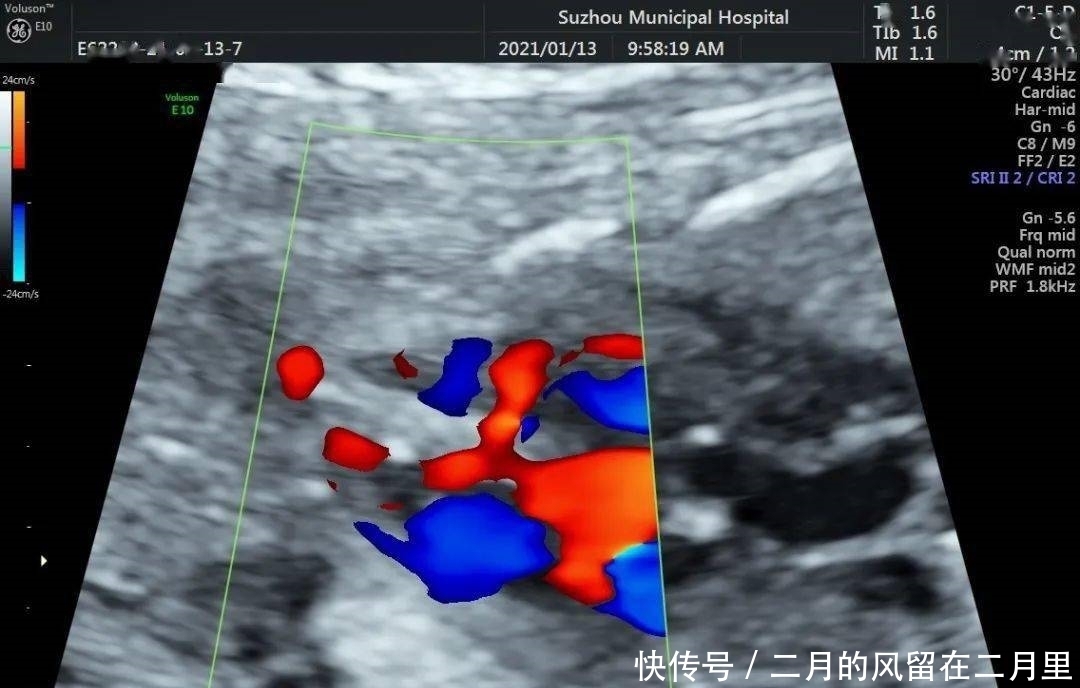 胎儿室缺,超声医师心中的痛