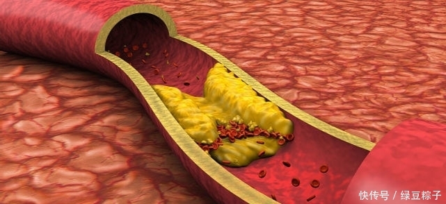 醫(yī)生提醒:血脂較高的人,盡量少吃三樣水果,或可助你穩(wěn)定血脂