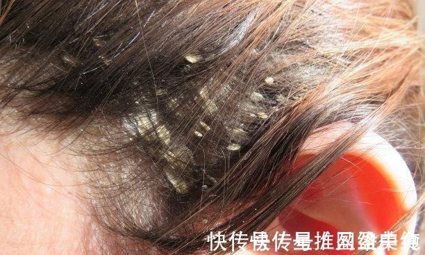 头发|用硫磺皂洗头发有哪些好处,需要注意哪些事项呢?