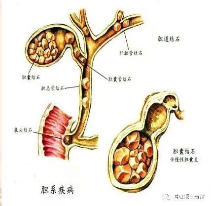 看完这篇，你就明白胆结石是怎么回事了