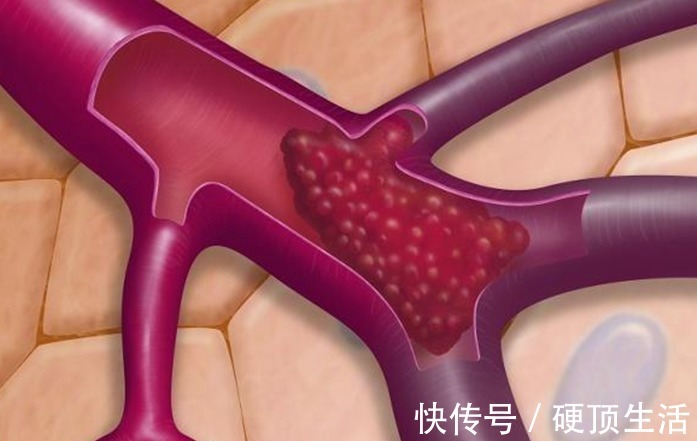 废物|三高“怕''你吃一物,化血栓,强心脏,很多人却当废物扔掉