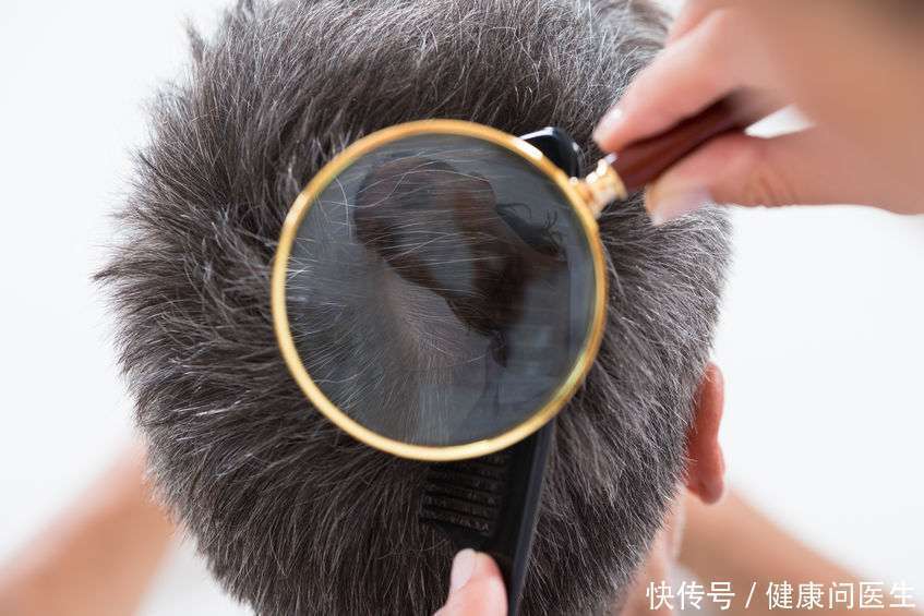 头皮经常痒,用手一挠抠出的“白泥”是什么?大部分人都不知道