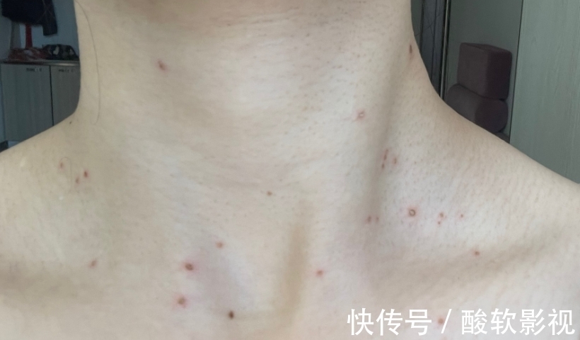 寻常疣|身体3个地方发痒,是HPV来了,趁早去检查,别误以为是过敏