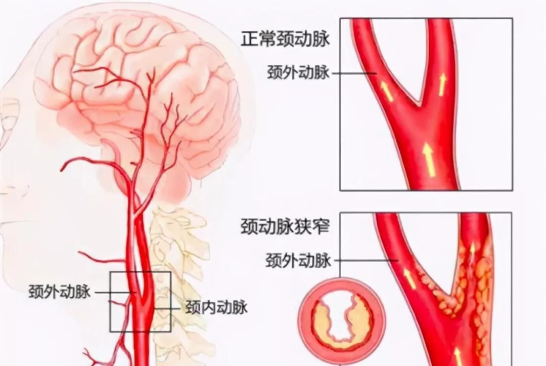 颈动脉狭窄|警惕脑卒中“隐形杀手”：颈动脉狭窄