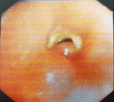 蓝军|都是辣椒尖惹的祸!中国科学院大学重庆仁济医院呼吸与危重症医学科顺利完成支气管异物取出术