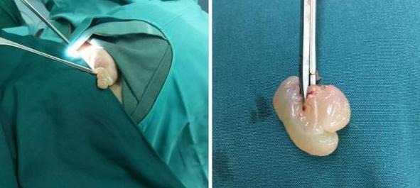 鼻炎|以为是鼻炎,结果查出来鼻息肉!会不会癌变,要不要手术切掉