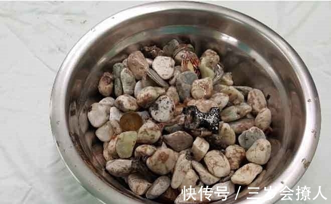 医院|男子腹痛送医院，医生取出2公斤“垃圾”，男子回答:焦虑时爱吃