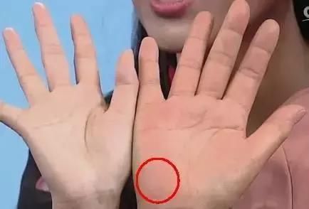 健康|觀手知健康！快速辨識高血壓、高血糖就這么看，2分鐘學會！